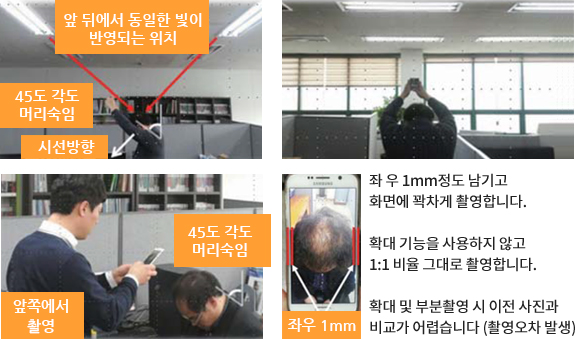 ps_modal_img 두피 셀카 찍기 요령 (휴대폰 촬영)